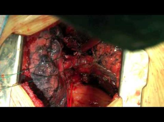 Oberlappenresektion mit bronchoplastischer Anastomose