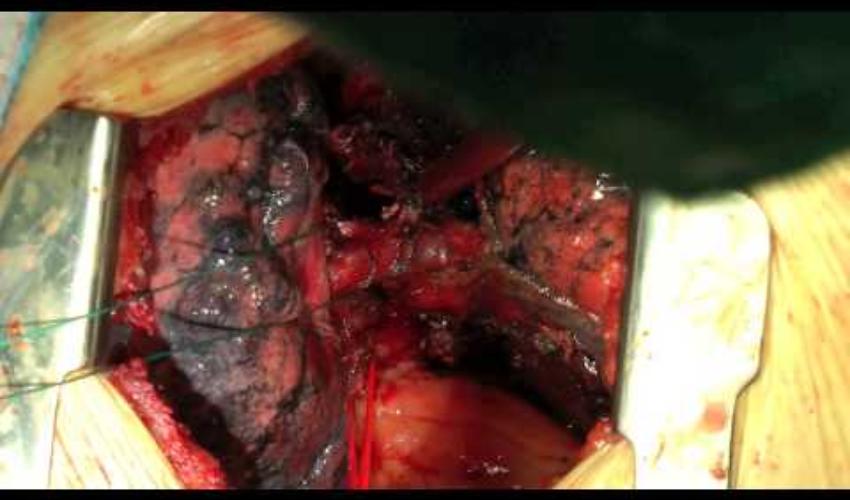 Oberlappenresektion mit bronchoplastischer Anastomose